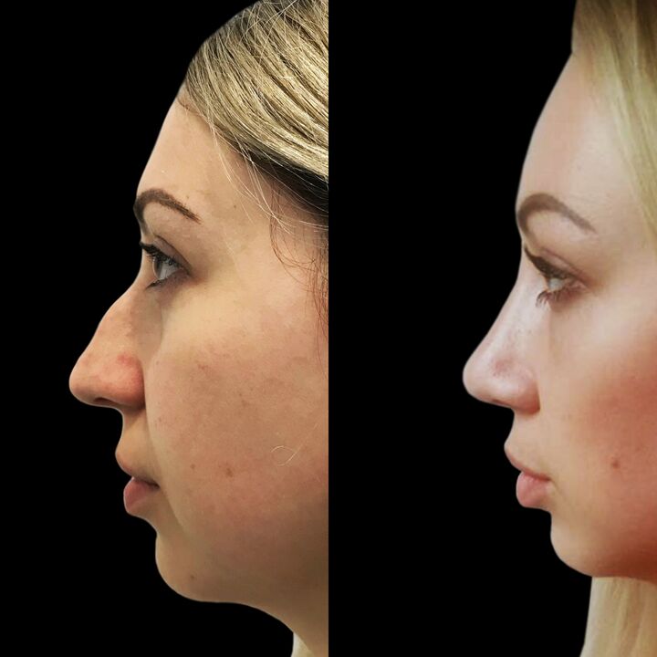 Rinoplastyka