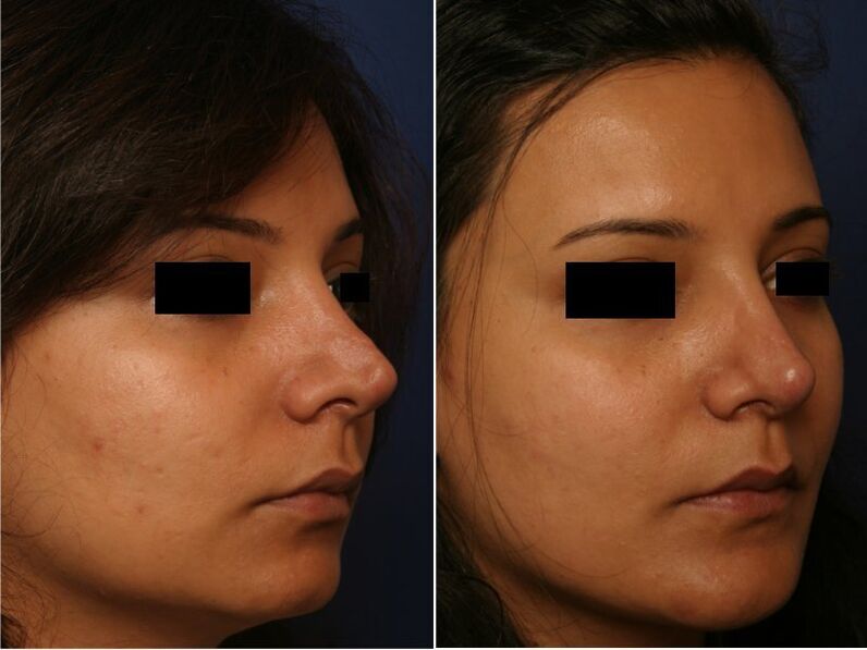 wynik operacji plastycznej