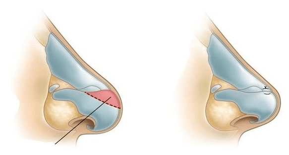 Korekcja kształtu nosa