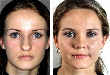 przed i po korekcji nosa