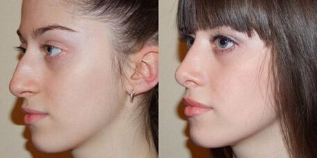 zdjęcia przed i po korekcji nosa