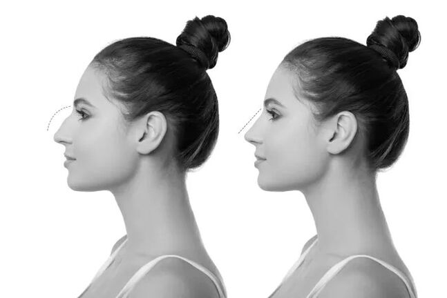 nos przed i po operacji plastycznej