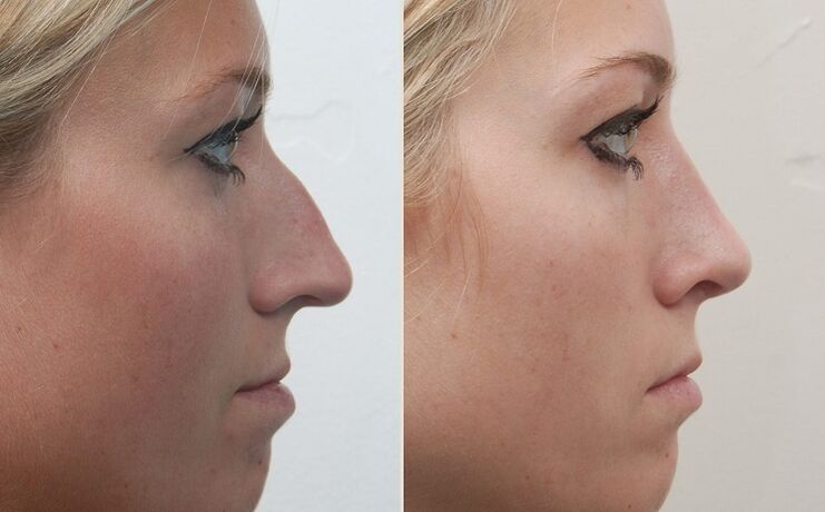 przed i po plastyce nosa