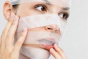 dziewczyna w bandażach po plastyce nosa