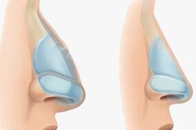 nos przed i po plastyce nosa