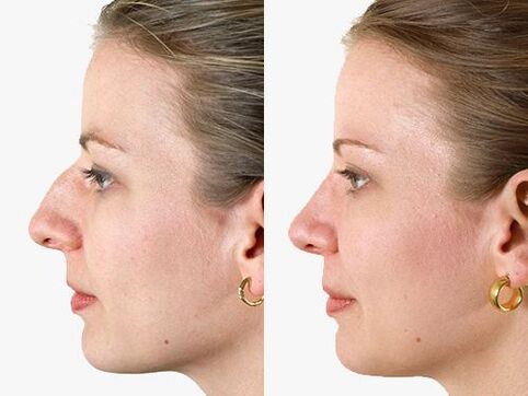 zdjęcia przed i po plastyce nosa