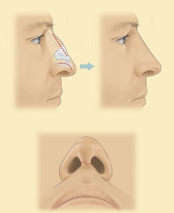 schemat plastyki nosa