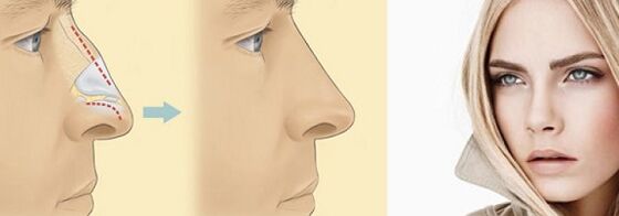 korekcja kształtu nosa za pomocą niechirurgicznej plastyki nosa