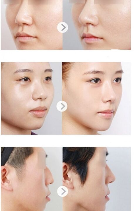 przed i po niechirurgicznej plastyce nosa