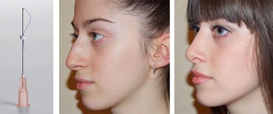 przed i po plastyce nosa z mezonitkami