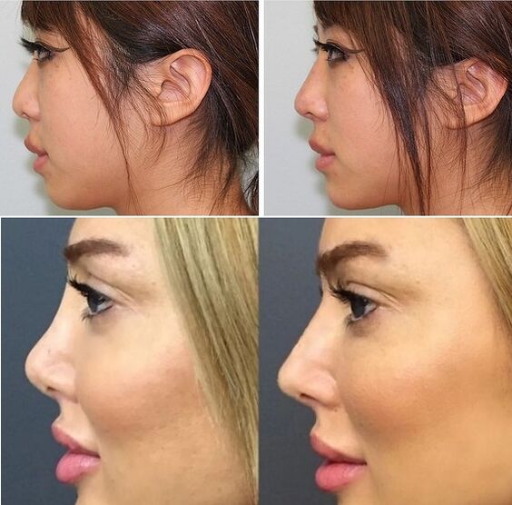 zdjęcia przed i po niechirurgicznej plastyce nosa