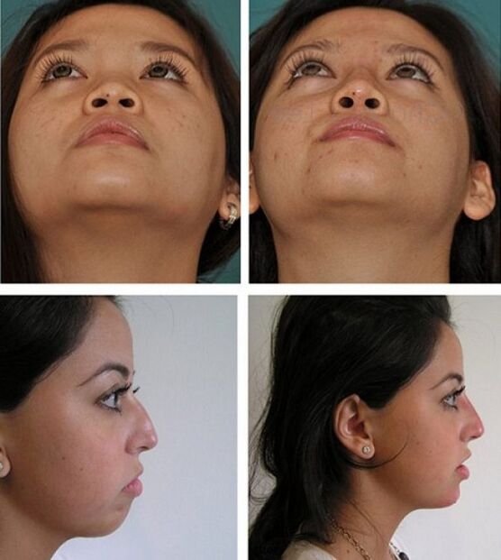 zdjęcia przed i po rynoplastyce bez operacji