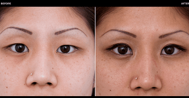 przed i po operacji oka