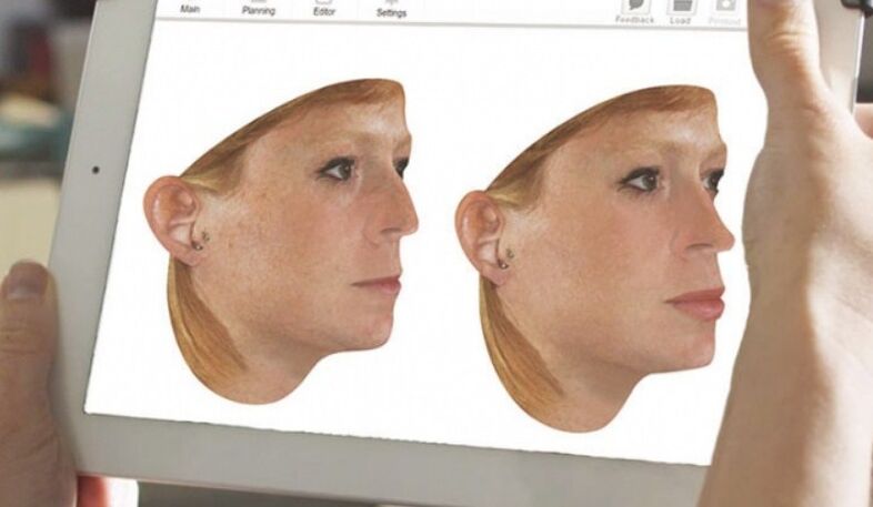 Metoda komputerowego modelowania nosa przed rynoplastyką