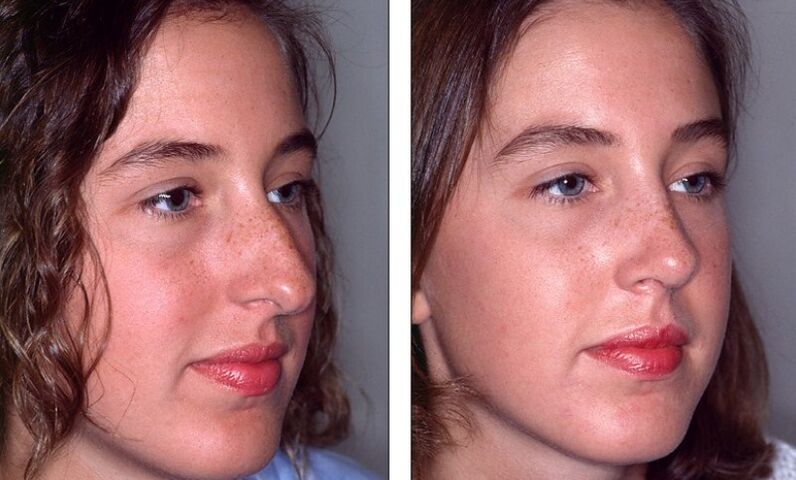 Nos przed i po nieudanej plastyce nosa