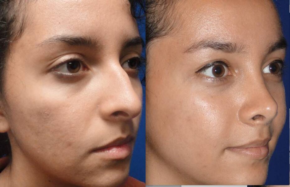 zdjęcia przed i po zamkniętej korekcji nosa