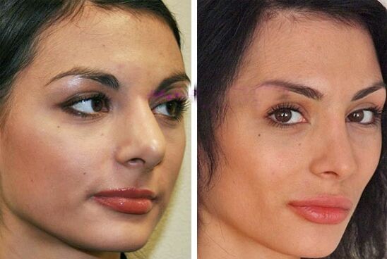 nos przed i po operacji plastycznej