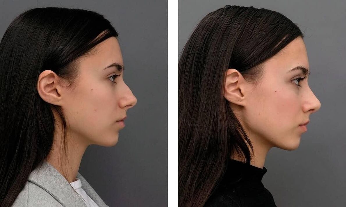 zdjęcia przed i po plastyce nosa