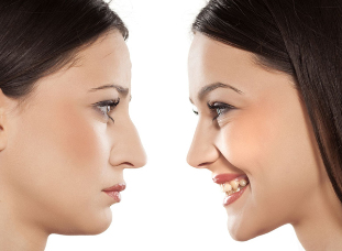 Korekcja nosa przed i po