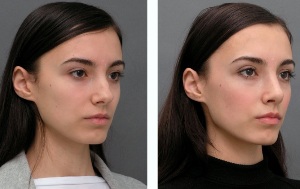 Dziewczyna przed i po nosa nosa