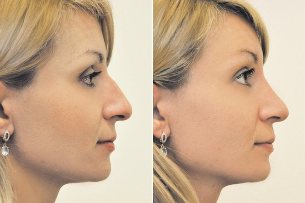 Chirurgiczne nosa, zdjęcia przed i po