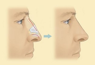 Jak przebiega delikatna korekcja nosa